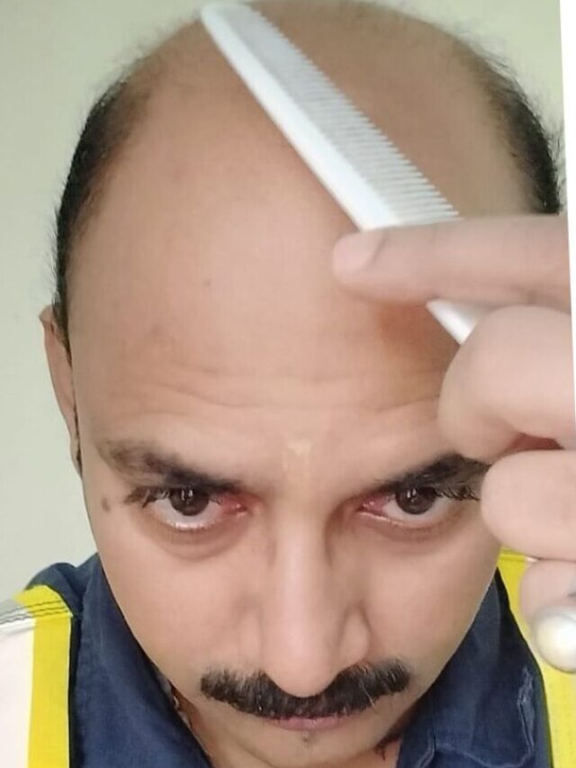 क्या विटामिन डी की कमी से बाल झड़ते हैं?